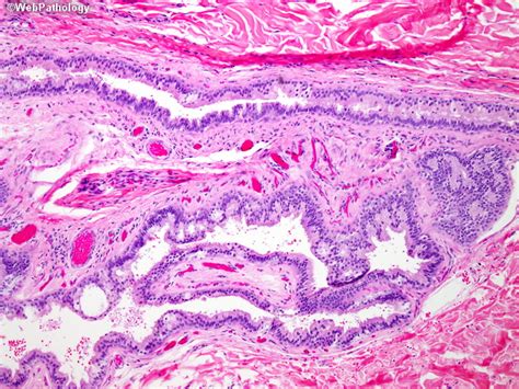 Webpathology.com: A Collection of Surgical Pathology Images