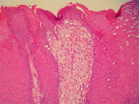 Xanthoma Histology