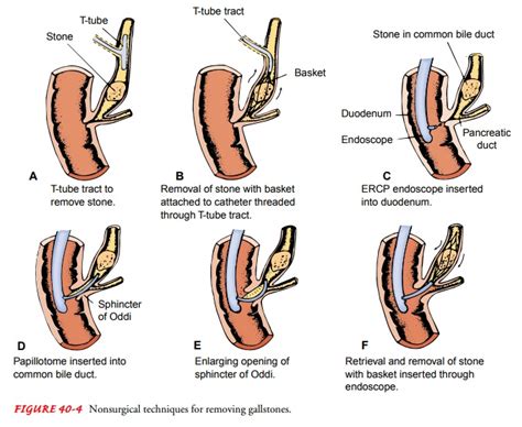 Cholelithiasis - Disorders of the Gallbladder