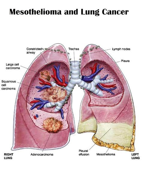 Testing Blog: Mesothelioma and Lung Cancer