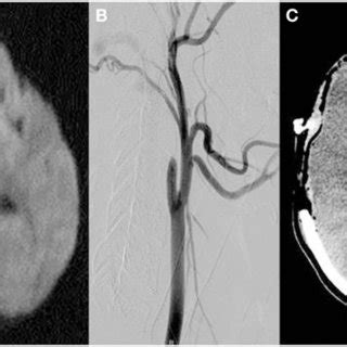 MRI diffusion-weighted images demonstrating restricted diffusion in the ...