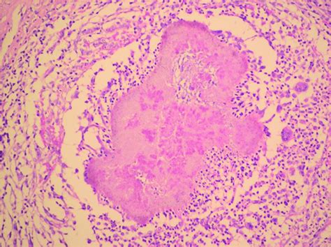 Histopathology shows granuloma with purulent exudate and actinomycotic... | Download Scientific ...