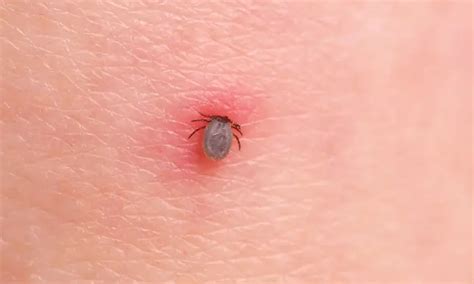 5 Diseases That Can Be Spread By Ticks | My Decorative