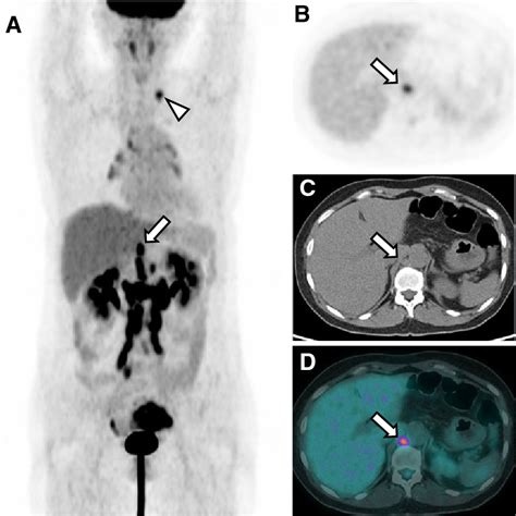 [PDF] Retrocrural Lymph Node Metastasis Disclosed by 18F-FDG PET/CT: A Predictor of Supra ...