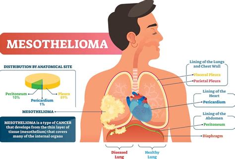 Causes and symptoms of mesothelioma cancer - News Corner