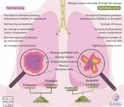 Understanding the airway remodeling in asthma and its main elements – protease and protease ...