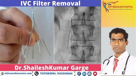 IVC Filter Removal Live Demo By Dr Shaileshkumar Garge | Citi Vascular Hospital - YouTube