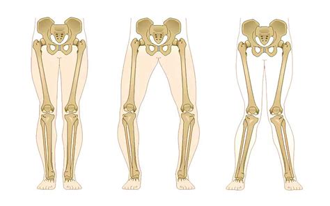 High Tibial osteotomy and leg corrective deformities - Dr Issam Mardini