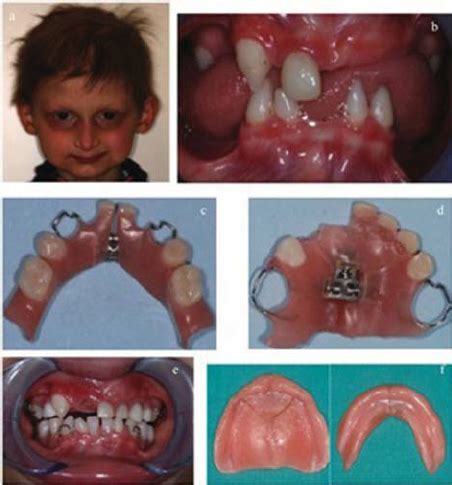 (A) Typical facies of a patient with ectodermal dysplasia. (B) Dental ...