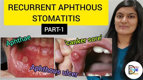 Aphthous Stomatitis: What Is It, Symptoms, And More Osmosis, 58% OFF