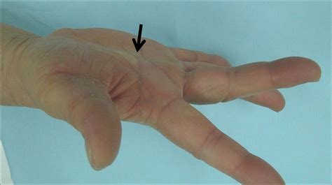 A Sixty-two-Year-Old Woman with Painful Triggering at the Metacarpophalangeal Joint of the Right ...