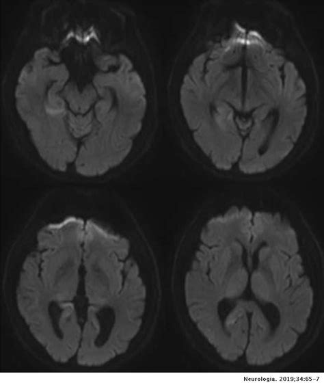 Muscle atrophy and fasciculations as a manifestation of sporadic ...