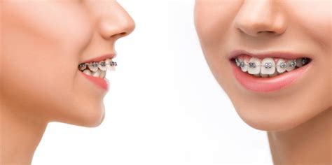 How To Fix A Misaligned Jaw - Belmar Orthodontics