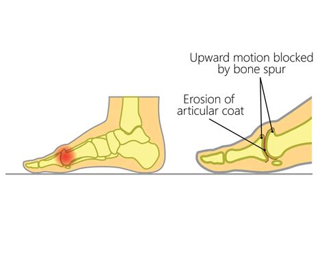 What is Hallux Rigidus & Its Impact on Toe Movement? - Upswing Health