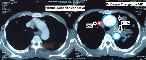 Chest Medicine Made Easy-Dr Deepu: Image Archives SVC obstruction- CT findings