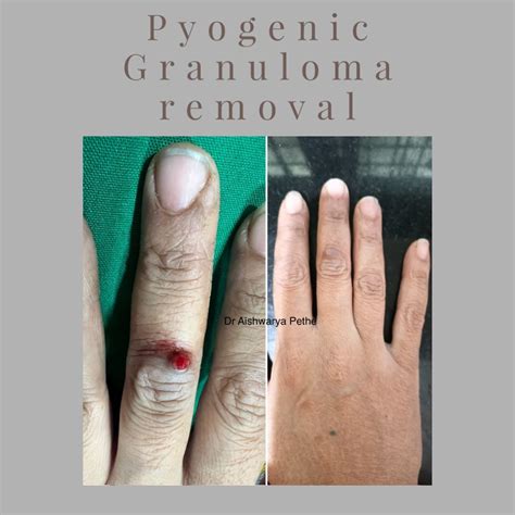 Removal of Pyogenic Granuloma by Radiofrequency Ab