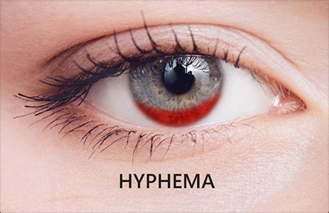 Symptoms of Hyphema Archives | Dr. Vikram Chauhan's Blog