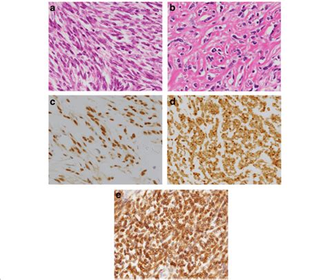 Histology and immunohistochemistry of the malignant solitary fibrous ...