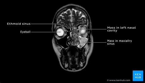 Schwannoma of the nasal cavity: Clinical case, diagnosis | Kenhub