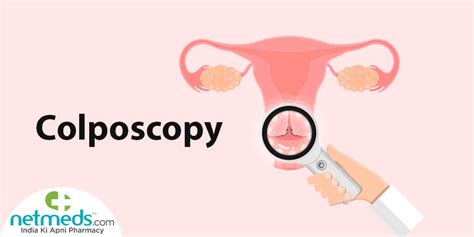 Colposcopy: Procedure, Risks And Results | Netmeds