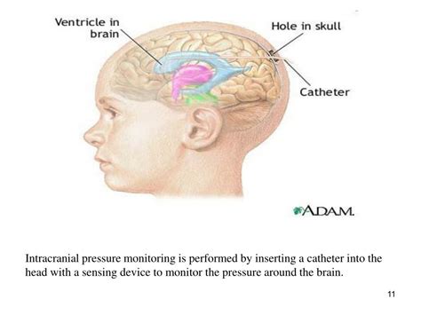 PPT - Increased Intracranial Pressure (ICP) PowerPoint Presentation - ID:390801