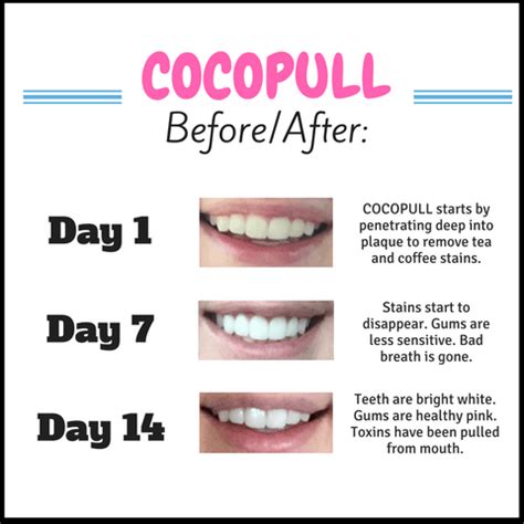 Coconut Oil Pulling Teeth Before And After - Teeth Poster