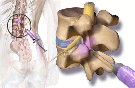 RFA Radiofrequency Ablation Surgery For Back Pain