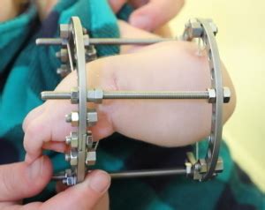 External Fixators | International Center for Limb Lengthening