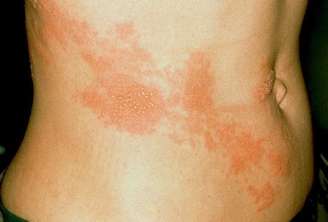 Shingles Contagious | Is Shingles Contagious | Shingles Pictures | Diseases Pictures