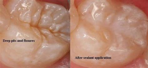 Sealants - Pediatric Dentist in Clifton, NJ - Dentistry for Children