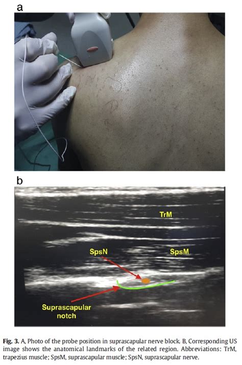 The Suprascapular Nerve Block - Sports Medicine Review