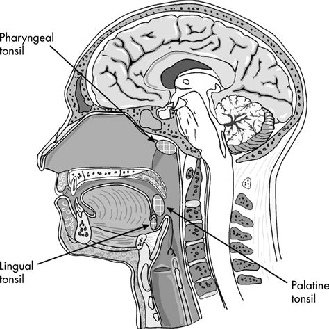 HPV infections and tonsillar carcinoma -- Syrjänen 57 (5): 449 -- Journal of Clinical Pathology