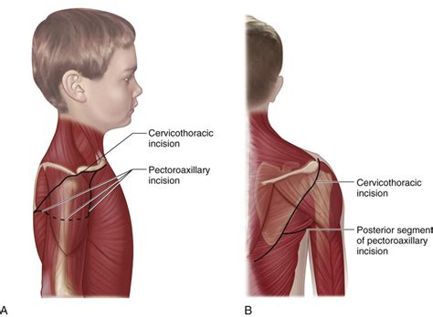 67 Posterior Approach for Forequarter Amputation (Littlewood Technique) | Musculoskeletal Key