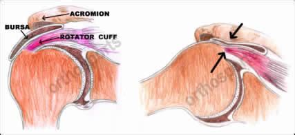 Shoulder Impingement Treatments, Orthosports Orthopaedic Surgeons