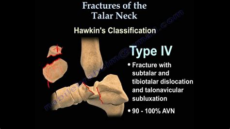 Talus fracture, Hawkin's Classificaiton - Everything You Need To Know ...