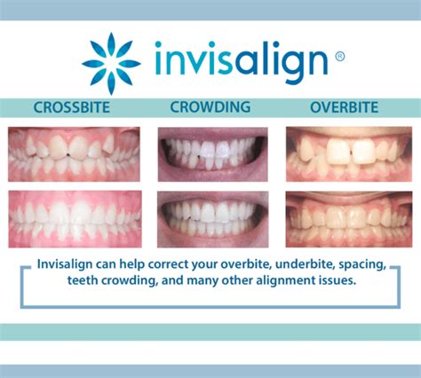 Invisalign Dentist Chillicothe, OH | Wissler Myers & Kallies Family ...