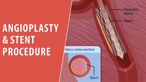 Angioplasty & Stent Procedure | Cardiac Rehab | Trusted Patient Education Platform