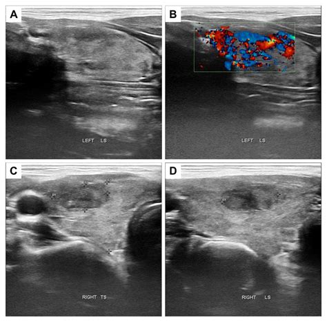 Bedside thyroid ultrasound scan showing an enlarged thyroid with ...