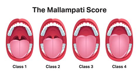 Mallampati Scoring