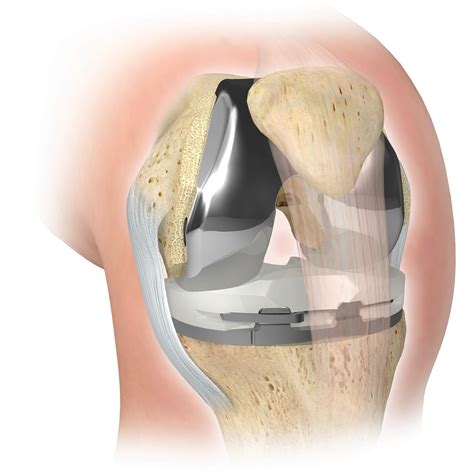 Knee Pain Relief - Surgical Treatment Options