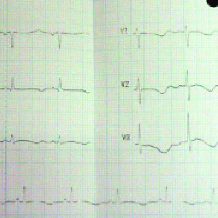 ECG showing QT prolongation with global T inversions. | Download Scientific Diagram