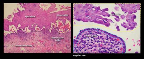 Pemphigus Vulgaris: Diagnosis, Treatment, and Prognosis