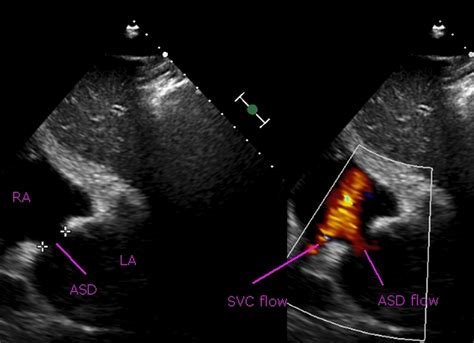 ASD on colour Doppler echocardiogram: 15 mm secundum ASD