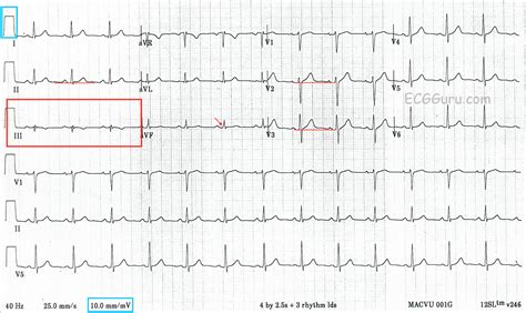 ECG Interpretation: ECG Blog #124 - Teaching by Using a Normal ECG (ECG Guru)