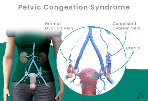 Pelvic Congestion - My Aim