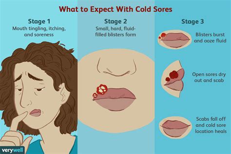 Stages of a Cold Sore Outbreak on Lips, Nose, and Face