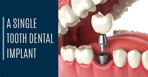 3 Types of Dental Implants | Which Implant Is Best for You? | Bellevue