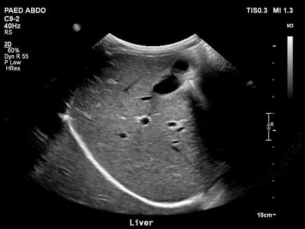 US abdomen (summary) | Radiology Reference Article | Radiopaedia.org