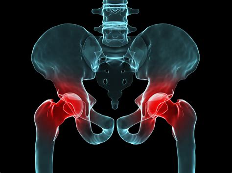 Hip Bursitis Can Cause Pain and Impede Mobility - University Health News