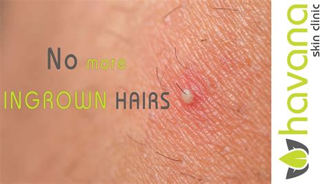 Laser hair removal | Ingrown Hairs - YouTube